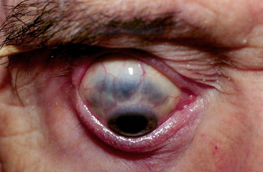 The three primary colors are red, blue, and yellow. STAFILOM OF THE SCLERA | Optometry Today